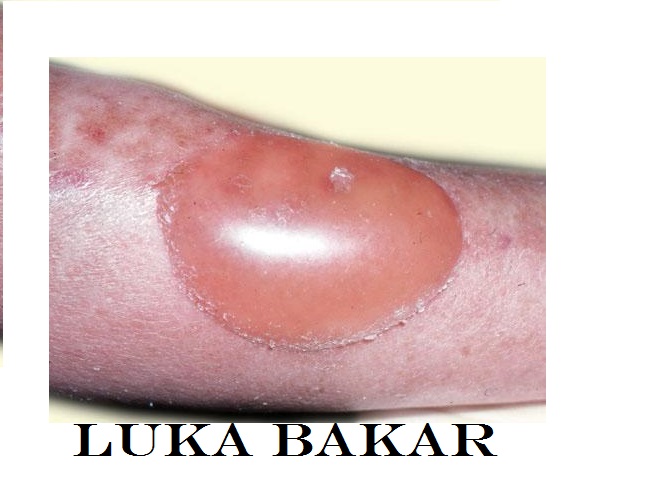 luka bakar
